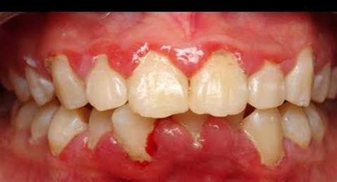 Gingivitis 3 Home Remedies To Get Rid Of This Gum Disease Pulse Ghana
