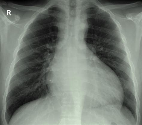Aortic Regurgitation Chest X Ray Wikidoc