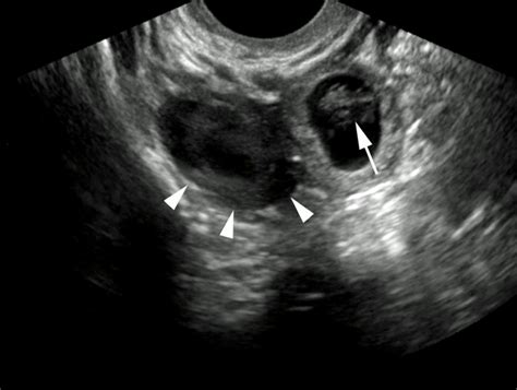 Condition Specific Radiology Ectopic Pregnancy Stepwards