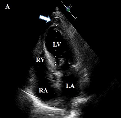 Left Ventricular Pseudo Aneurysm With Ventricular Septal Perforation
