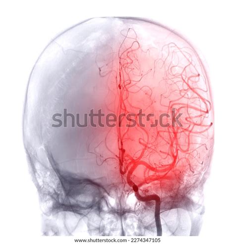 Cerebral Angiography Image Fluoroscopy Intervention Radiology Stock