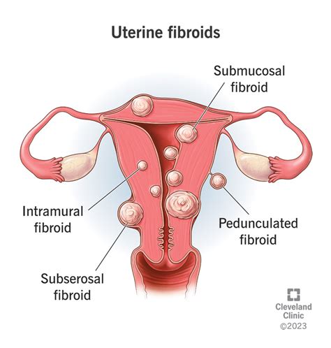 understanding fibroids causes symptoms and treatments ask the nurse expert