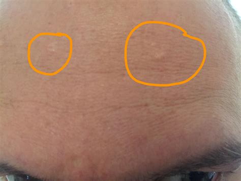 Skin Concerns Small Skin Coloured Lumps Appearing On Forehead Not