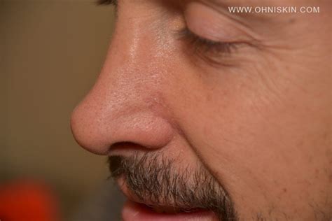 Basal Cell Carcinoma Of The Nose And Nasal Reconstruction
