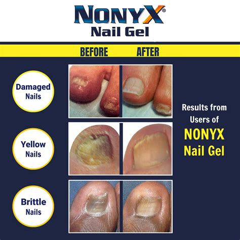 Nonyx Fungal Nail Clarifying Gel Rids Toenails Of Fungus By Removing Keratin Debris Where Nail