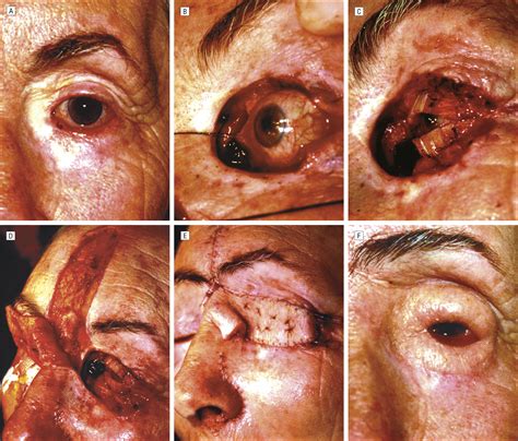 Techniques and Outcomes of Total Upper and Lower Eyelid Reconstruction ...