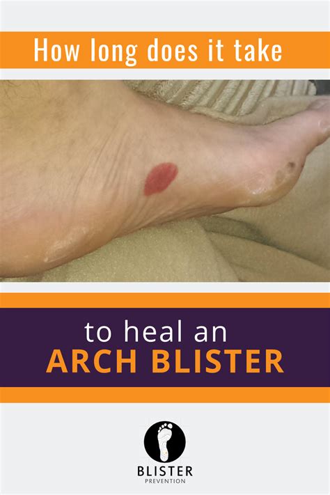 How Long Do Blisters Take To Heal On Feet