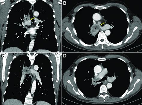 Preoperative Computed Tomography A And B Coronal And Axial Views