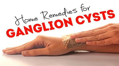 How To Remove Ganglion Cyst At Home Duane Pickrell Kapsels Reverasite