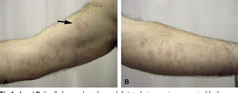 Figure 1 From A Patient With Clinicopathologic Features Of Small Plaque
