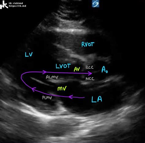 Cardiac Transthoracic Echocardiography Tte Summary And Labeled