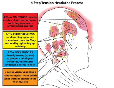 Treating Tension Headaches Trigger Point Therapy Tension Type
