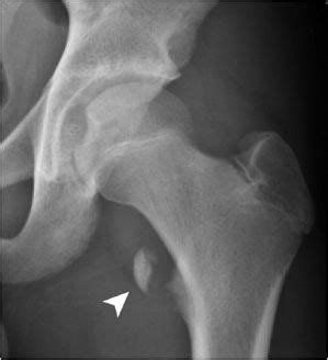 Lesser trochanter bsis are less common compared with femoral neck bsis. Pediatric Skeletal Trauma | Radiology Key