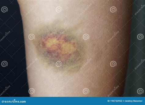 A Large Bruise On A Woman S Leg Stock Photo Image Of Woman Blue