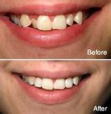 Teeth Bonding Insurance Pictures