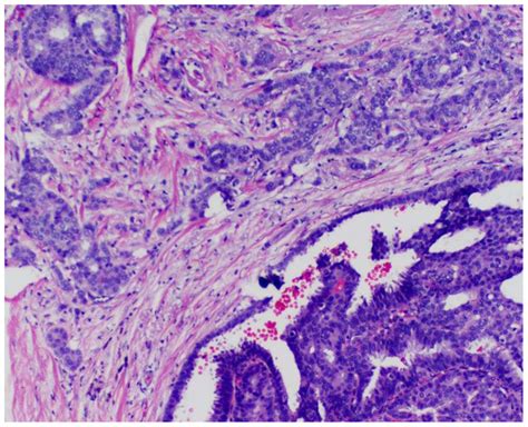 Encapsulated Papillary Carcinoma With An Invasive Component Download