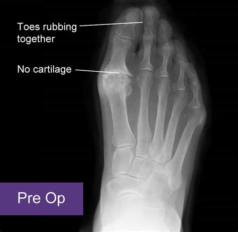 Hallux Rigidus Arthritis Of The Big Toe Orthopaedics And Trauma London