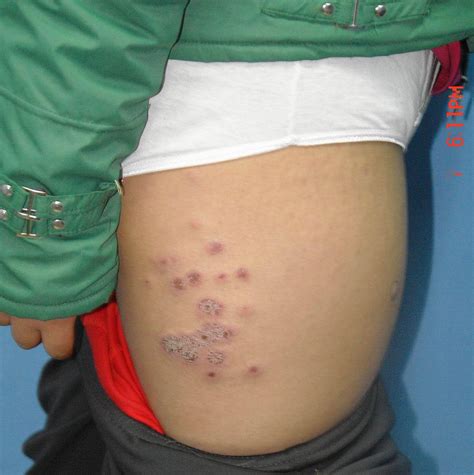 Lupus can be hard to detect because it is a complex disease that has many symptoms, and they can come on slowly. Symptoms Of: Symptoms Of Lupus