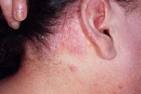 Types Of Psoriasis Causes Symptoms Treatment Systemic Disease In