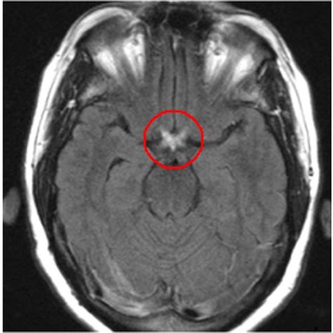Mri Of A Patient With Nmo Showing Inflammation Circled In Red Of Both
