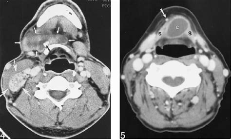 Pdf The Ct Appearance Of Thyroglossal Duct Carcinoma Semantic Scholar