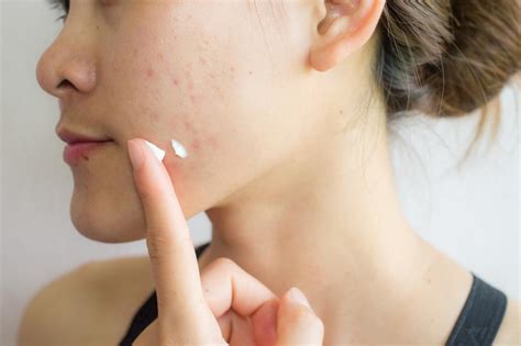 How To Get Rid Of Acne Scars Treatments And Home Remedies Elegancy