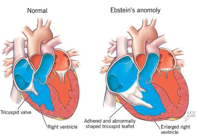 Ebstein S Anomaly For Adults Cleveland Clinic