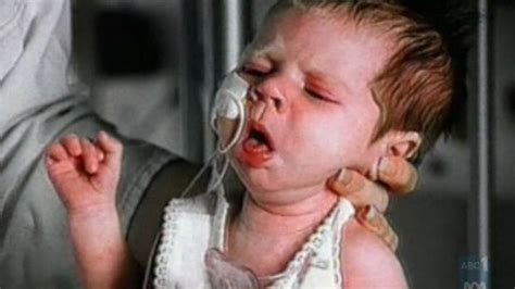 Symptoms Whooping Cough