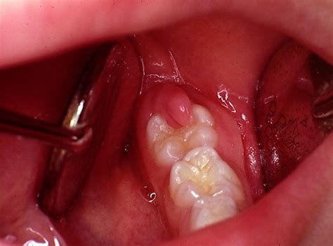 Operculectomy Dental Health Dental Fun Dental
