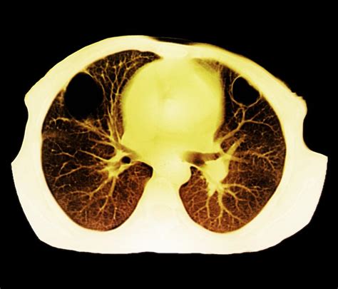 Lung Abscess Ct Scan Photograph By Zephyr Pixels