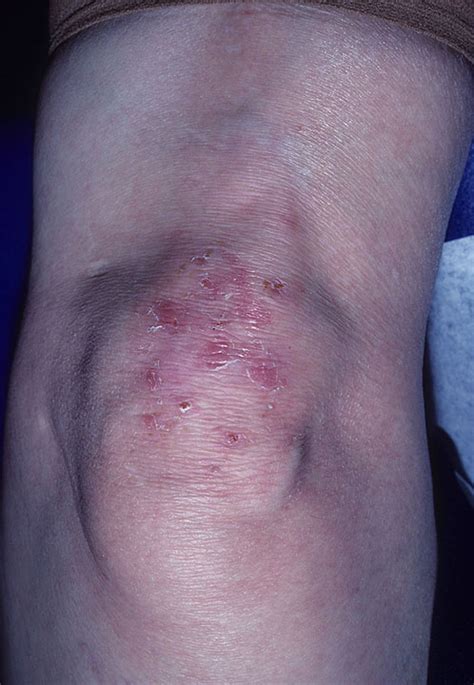 Dermatitis Herpetiformis Duhrings Disease