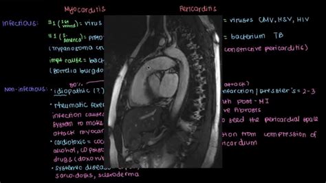 Murine models of enteroviral myocarditis suggest viral myocarditis is characterized by 3 phases. Causes of myocarditis and pericarditis - YouTube