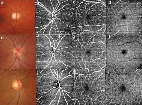 Optic Nerve Head Photography And Octa Images Of The Optic Disc Area