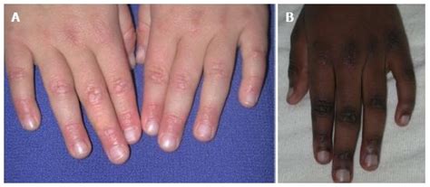 Review Of The Cutaneous Manifestations Of Autoimmune