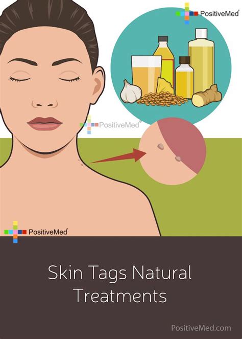 8 easy ways to remove skin tags without seeing a doctor skin tag removal skin tags home