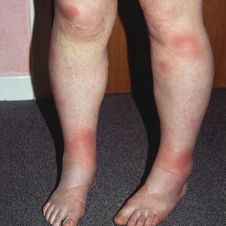 What Are The Sore Red Lesions On This Woman S Legs Pulse Today