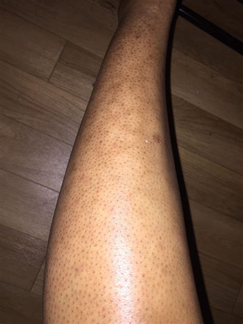 One Day After Shaving The Leg I Think It Is Keratosis Pilaris But My
