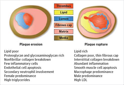 Updates On Acute Coronary Syndrome A Review Acute Coronary Syndromes