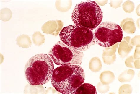 Acute Promyelocytic Leukaemia Photograph By Science Photo Library Pixels