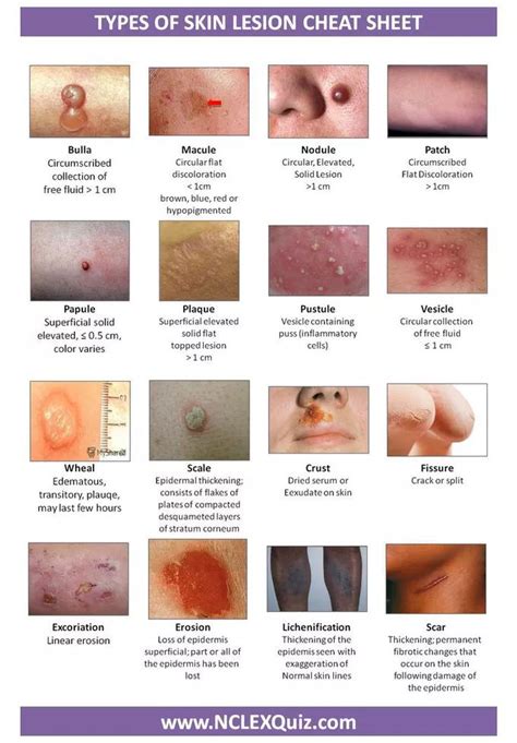 Medizzy Types Of Skin Lesion Cheat Sheet Nursing Student Tips