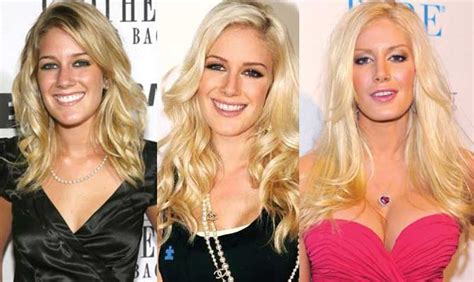 Heidi Montag Before And After Nose Job