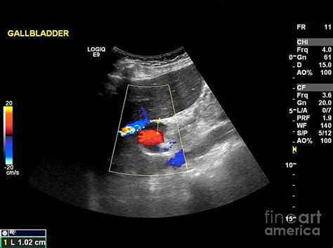 Gallstone Ultrasound Scan 2 Photograph By Science Photo Library
