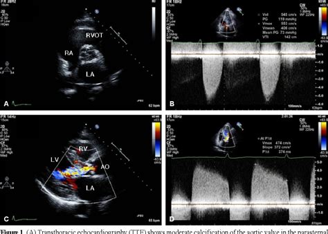 Figure 1 From A Quadricuspid Aortic Valve Associated With Severe Aortic