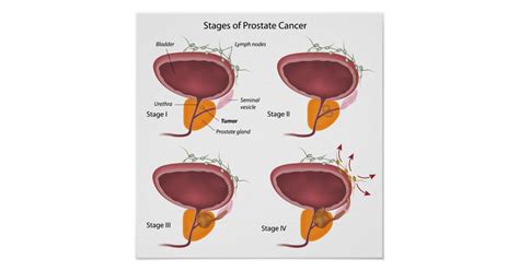 Stages Of Prostate Cancer Poster Uk