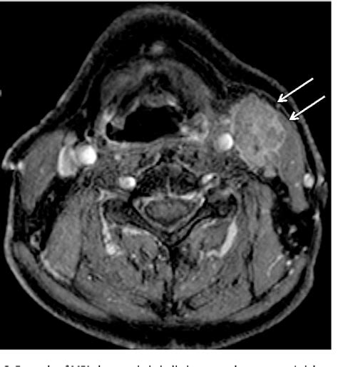Figure 2 From Can Extranodal Spread In Head And Neck Cancer Be Detected