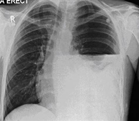 Spontaneous Haemopneumothorax Bmj Case Reports
