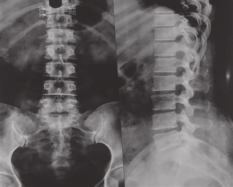 X Ray Showing Loss Of Lumbar Lordosis Fig 2 Magnetic Resonance