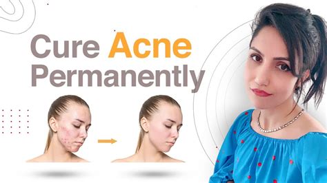 How To Get Rid Of Acne Forever Remove Acne Permanently In Hindi