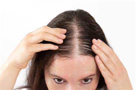 Female Fue Hair Restoration In Miami Fl With Dr Anthony Bared