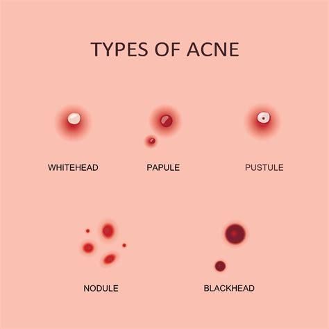 List 98 Images Types Of Acne With Pictures Updated 122023